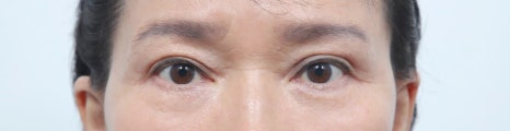 Upper Blepharoplasty: How to Improve Covered, Drooping Eyelids image 6
