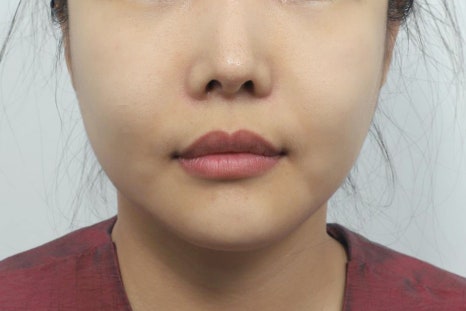 Philtrum Reduction for Middle-Aged Patients: Correcting the Lengthening Area Between the Nose and Upper Lip with Age image 2