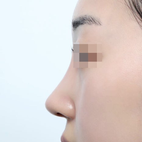 코성형 후 붓기와 회복, 몇 주 차에 어떻게 달라지나 관련 이미지 8