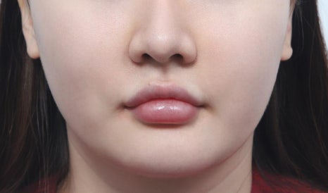 신사동 실리프팅, 어떤 실을 어떻게 넣느냐가 결과를 가릅니다 관련 이미지 5