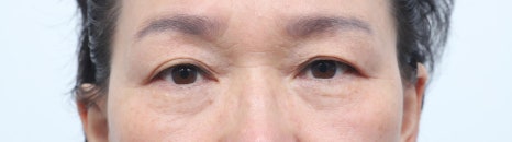 Lower Eyelid and Upper Eyelid Surgery: Should They Be Performed Together as You Age? image 6