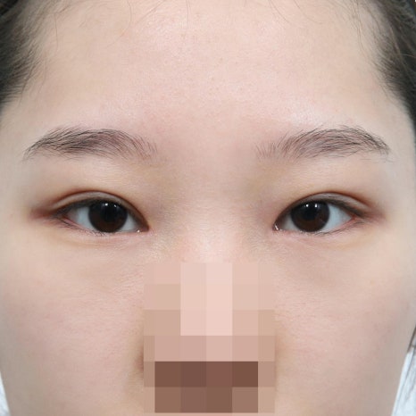 쌍꺼풀수술 재수술 시기, 언제 시작하는 게 좋을까? 관련 이미지 4