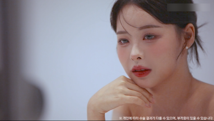 눈밑지방재배치수술 리얼후기 2탄｜수술 한달 후 경과확인! 관련 이미지 17