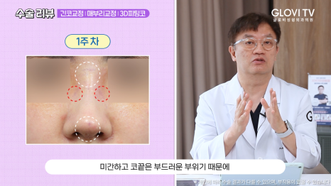 매부리코 긴코 코성형 리뷰, 글로비 3D 피팅코수술 관련 이미지 8