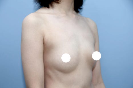 압구정 가슴수술, 보형물 선택부터 틀리면 결과도 틀립니다 관련 이미지 3