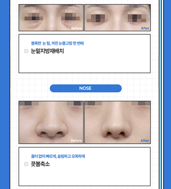[글로비성형외과] 여름방학 이벤트! 눈&middot;코&middot;바디 라인 혜택 정리 관련 이미지 3