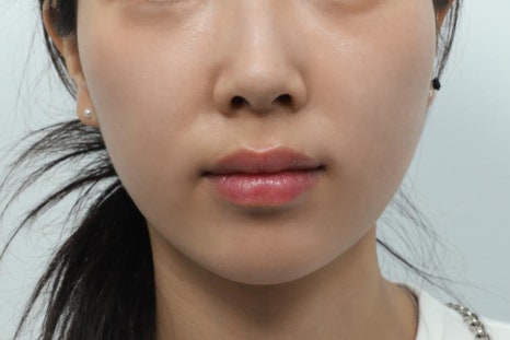 Philtrum Reduction Review: The Real Story No One Tells You image 8