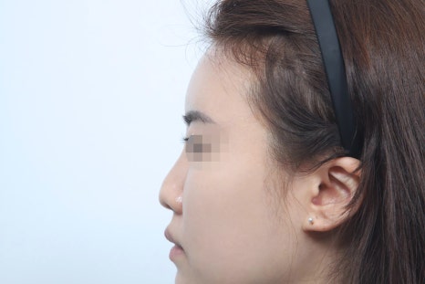 Analysis of the Causes of Failed Revision Rhinoplasty in Seoul and Personalized Plans image 3