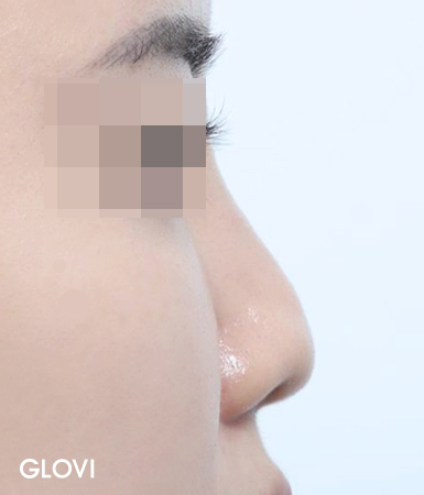 압구정 코재수술, 실패의 원인부터 분석해야 하는 이유 관련 이미지 3