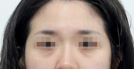 강남 눈밑지방재배치, 눈 밑 지방을 정리하는 방법 관련 이미지 2