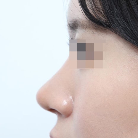 The Cost of Rhinoplasty for Women: A Smart Choice Between Safety and Price image 8