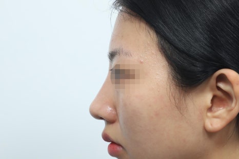 코성형 개방과 비개방, 나에게 맞는 수술방식이 궁금하다면 읽어보세요 관련 이미지 6