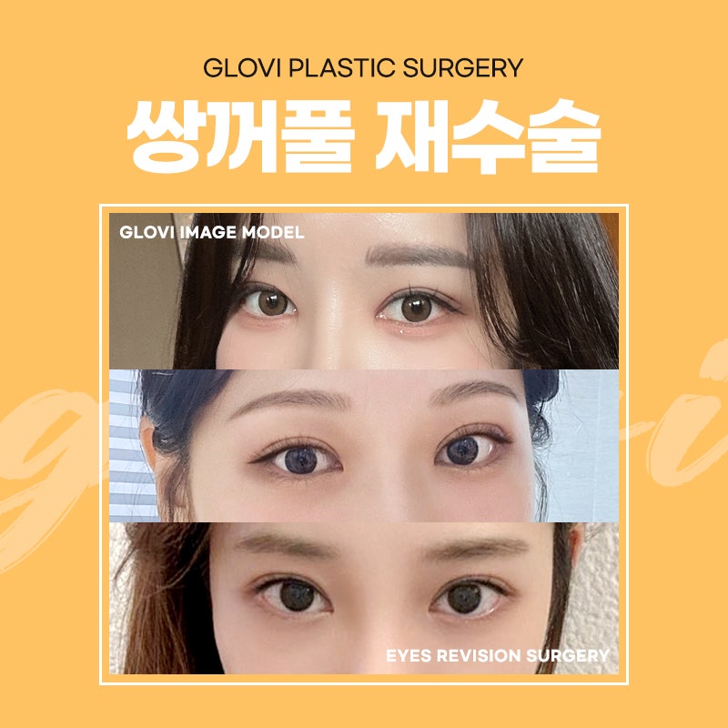 쌍꺼풀재수술잘하는병원 선택 전 주의사항 관련 이미지 5