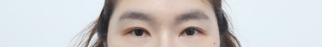 How Can Drooping Upper Eyelids Be Improved in Middle Age? image 9