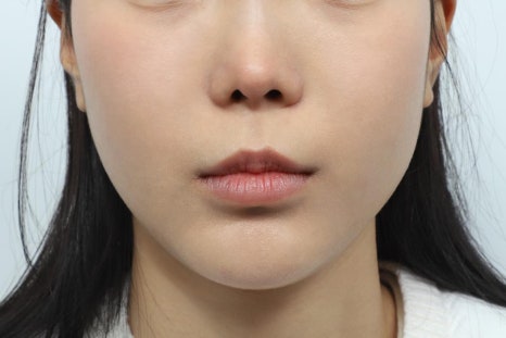 인중축소술 전후, 수술 전 가장 많이 찾는 질문 관련 이미지 5