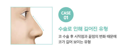 코성형 긴코, 어떻게 줄이고 자연스럽게 만들까? 관련 이미지 7