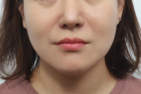 인중축소술 전후, 수술 전 가장 많이 찾는 질문 관련 이미지 4