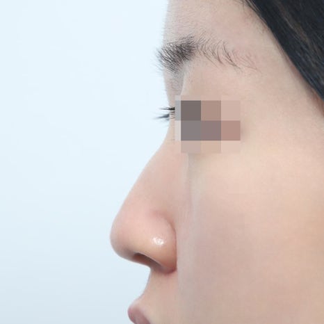 코성형 1개월 후 붓기 회복 상태와 일상생활 주의사항 관련 이미지 7