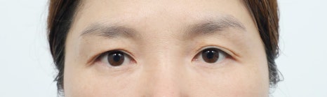 Double Eyelid Surgery in Middle Age: Improving Drooping Eyelids and Differences from Upper Blepharoplasty image 2