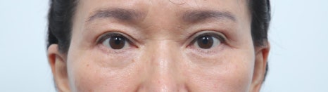 Lower Eyelid and Upper Eyelid Surgery: Should They Be Performed Together as You Age? image 7