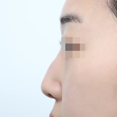 코성형 후 붓기와 회복, 몇 주 차에 어떻게 달라지나 관련 이미지 7