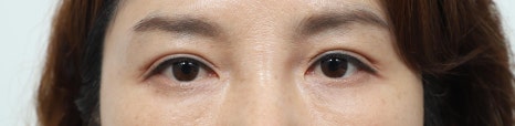 Lower Eyelid and Upper Eyelid Surgery: Should They Be Performed Together as You Age? image 3