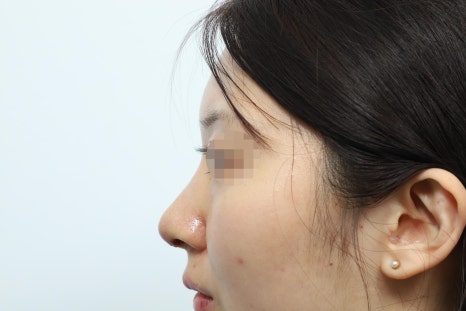 Autologous Dermal Graft Rhinoplasty: Read This If You’re Concerned About Resorption image 3