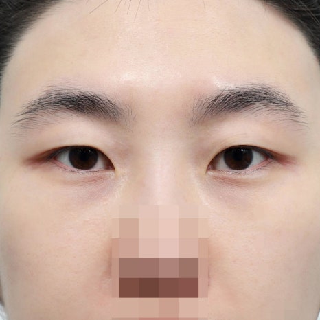 How to Apply Cold Compresses After Double Eyelid Surgery: Proper Swelling Care Guidelines image 6
