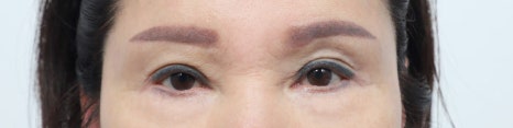 Middle-Aged Eye Surgery: Understanding Eye Surgery Options by Age image 3