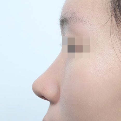 Short Nose Revision Surgery: First Identify the Cause of the Previous Failure image 7