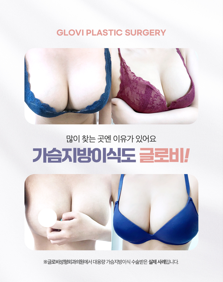 가슴지방이식가격과 가슴지방이식후 관리방법 관련 이미지 4