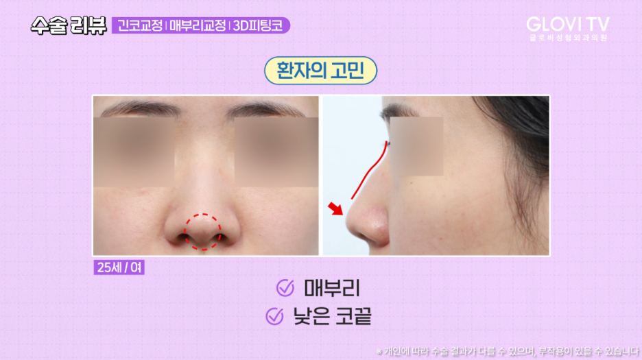 매부리코 긴코 코성형 리뷰, 글로비 3D 피팅코수술 관련 이미지 3