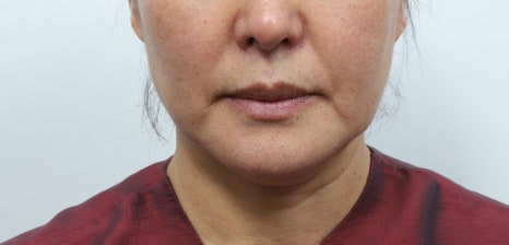 실리프팅 후 관리법, 효과를 오래 유지하는 습관 관련 이미지 6