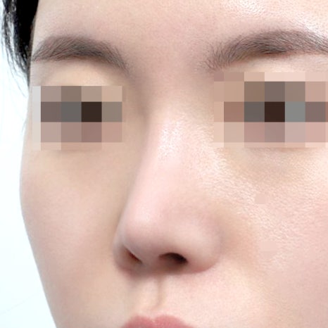 Can Implant-Free Rhinoplasty Really Look Natural Without a Prosthesis? image 5