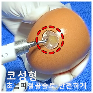 압구정역성형외과 코성형, 초음파절골술로 안전하게 관련 이미지 1