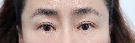 Middle-Aged Eye Surgery: Understanding Eye Surgery Options by Age image 8