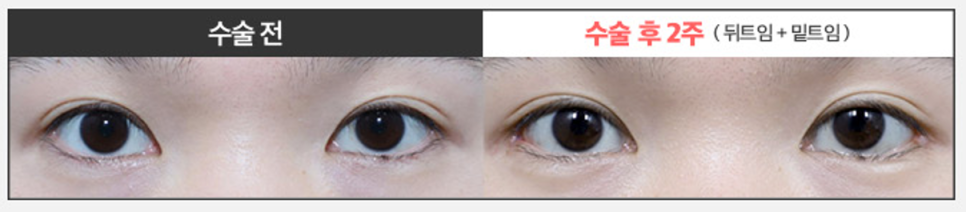 Worried About Re-adhesion After Lateral Canthoplasty? Those Concerns Disappear When the Surgical Technique Is Different image 11