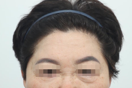 Lower Eyelid and Upper Eyelid Surgery: Should They Be Performed Together as You Age? image 4