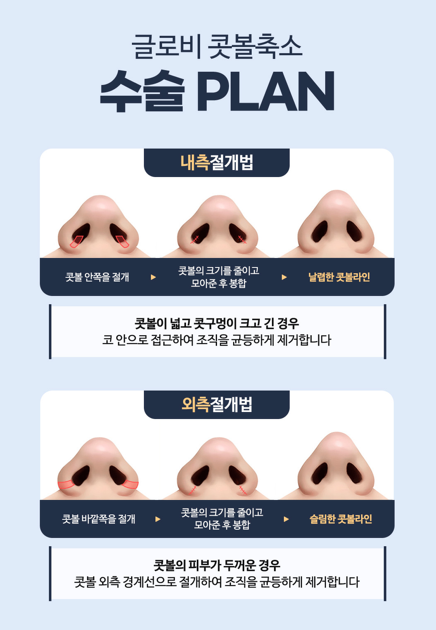 Alar Reduction Surgery: A Complete Guide to Design Methods for Different Types of Wide Noses image 5