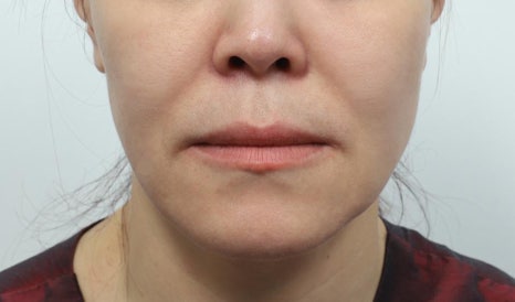 Sinsa Station Thread Lifting: What to Check When You’re Concerned About Skin Elasticity image 5