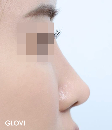 압구정 코재수술, 실패의 원인부터 분석해야 하는 이유 관련 이미지 4