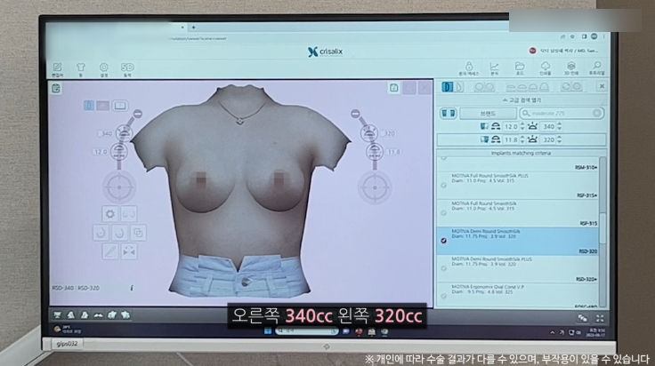 모티바가슴성형 리얼후기 1탄｜글로비성형외과의원 관련 이미지 10
