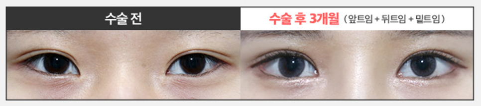 Worried About Re-adhesion After Lateral Canthoplasty? Those Concerns Disappear When the Surgical Technique Is Different image 8
