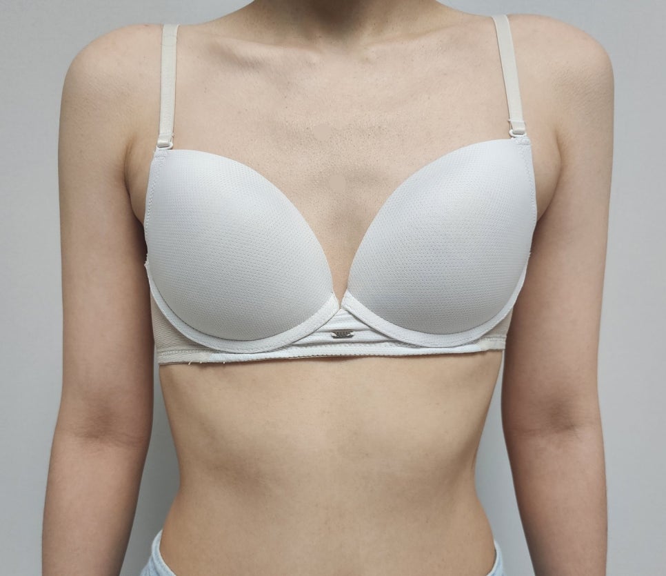 가슴수술 후 통증, 언제까지 얼마나 아픈 게 정상일까 관련 이미지 8