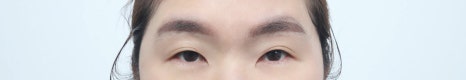 How Can Drooping Upper Eyelids Be Improved in Middle Age? image 8