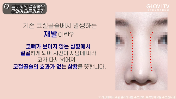 코성형 절골술, 재발률을 낮춘 새로운 방법 | 인터뷰 (1탄) 관련 이미지 20