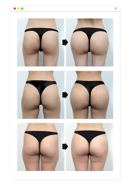 바디필러 잘하는곳? 시술 전에 이것부터 확인하세요 관련 이미지 2