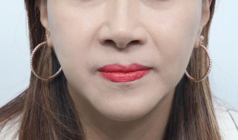 Thread-Lifting Swelling: Tips for Managing Swelling for a Quick Return to Daily Life image 9