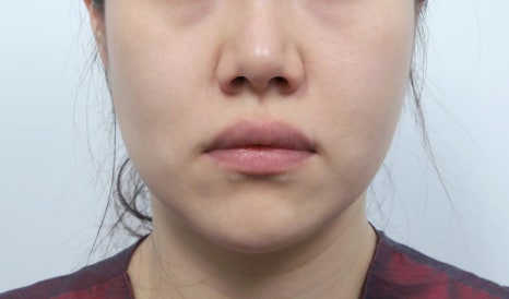 실리프팅 광대 부각, 처진 살 올리려다 얼굴 더 커 보이는 이유 관련 이미지 2