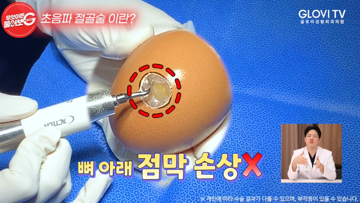 압구정역성형외과 코성형, 초음파절골술로 안전하게 관련 이미지 14